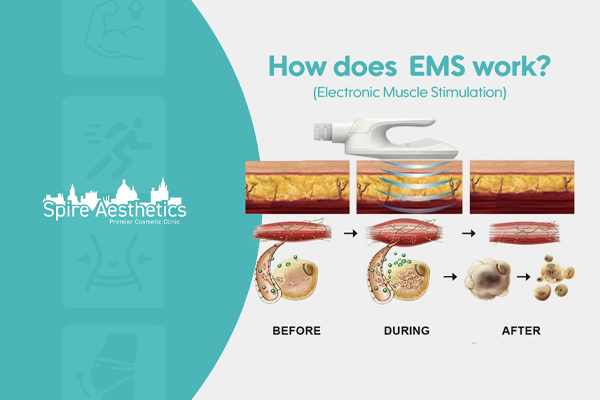 EMS treatment for post pregnancy weight loss treatment Malvern Link