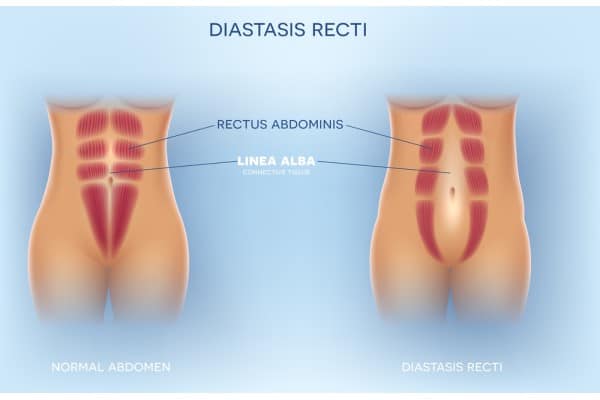 What Non-Surgical Options Are Available for Diastasis Recti Malvern Link?