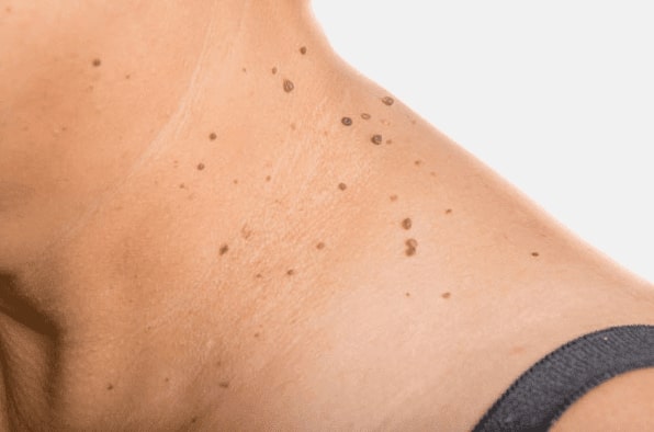 Are you looking for easy skin tag removal Malvern Link - then contact Spire today!