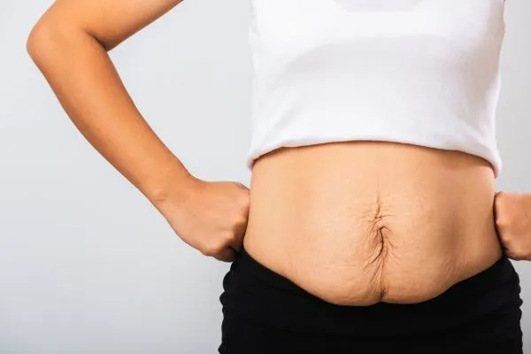 Image of a woman's stomach after weight loss with sagging skin following a gastric band Malvern Link