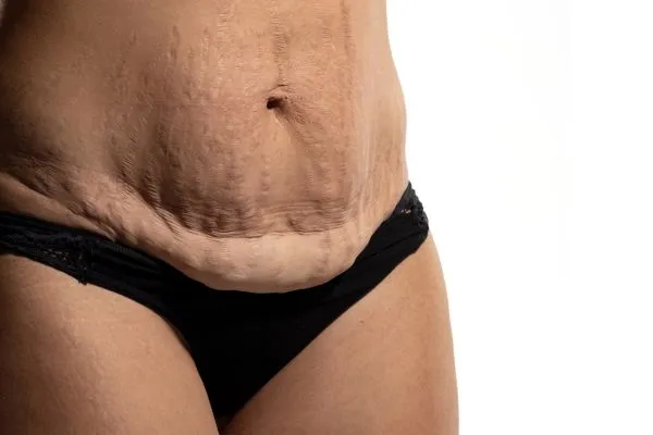 Image of womans stomach after weight loss injections Malvern Link showing saggy skin